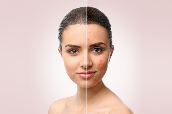 Qual è la verità sull’acne?