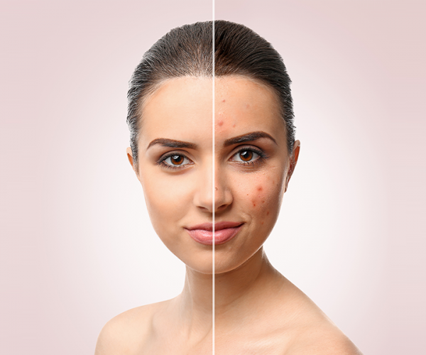 Qual è la verità sull’acne?