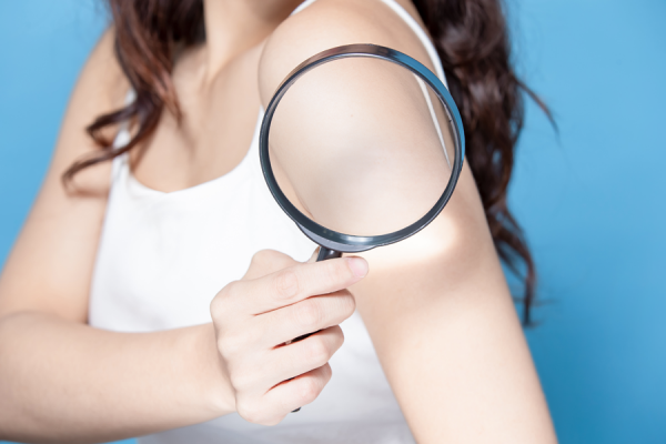 Riconoscere e trattare la psoriasi