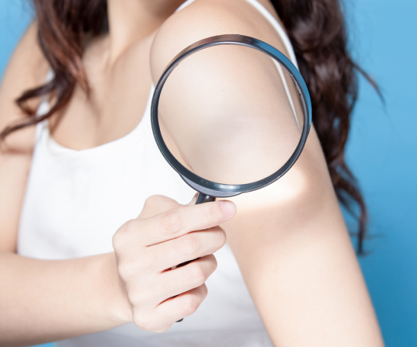 Riconoscere e trattare la psoriasi