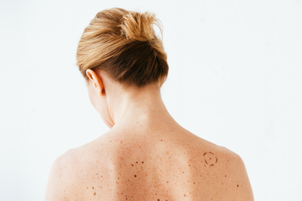 Melanoma: come riconoscerlo?