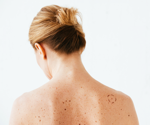 Melanoma: come riconoscerlo?