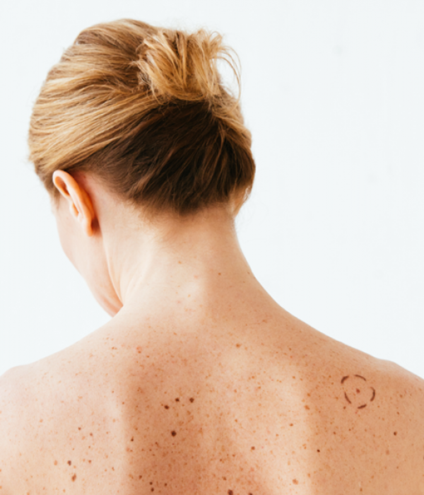 Melanoma: come riconoscerlo?