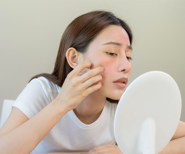 Sai riconoscere e trattare la dermatite?