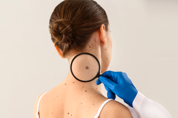 Scienza: la diagnosi di precisione in caso di melanoma.