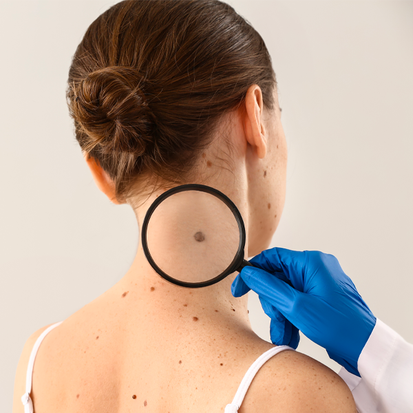 Scienza: la diagnosi di precisione in caso di melanoma.