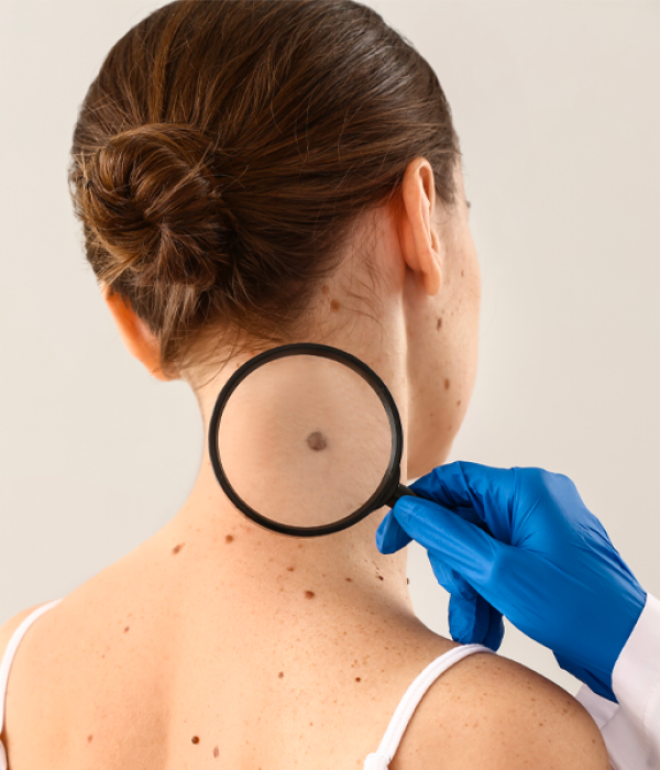 Scienza: la diagnosi di precisione in caso di melanoma.