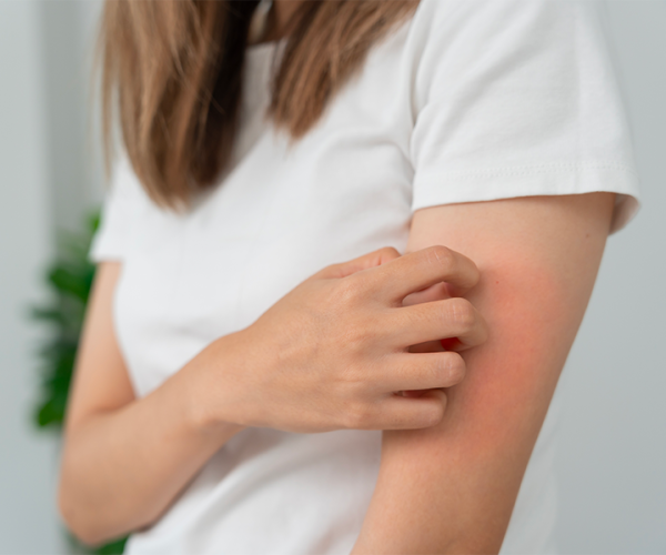 Allergia al nichel: sintomi, cause e prevenzione
