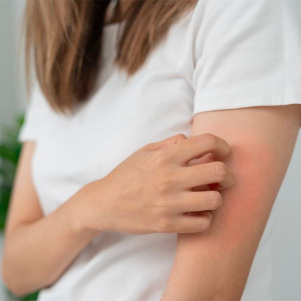 Allergia al nichel: sintomi, cause e prevenzione
